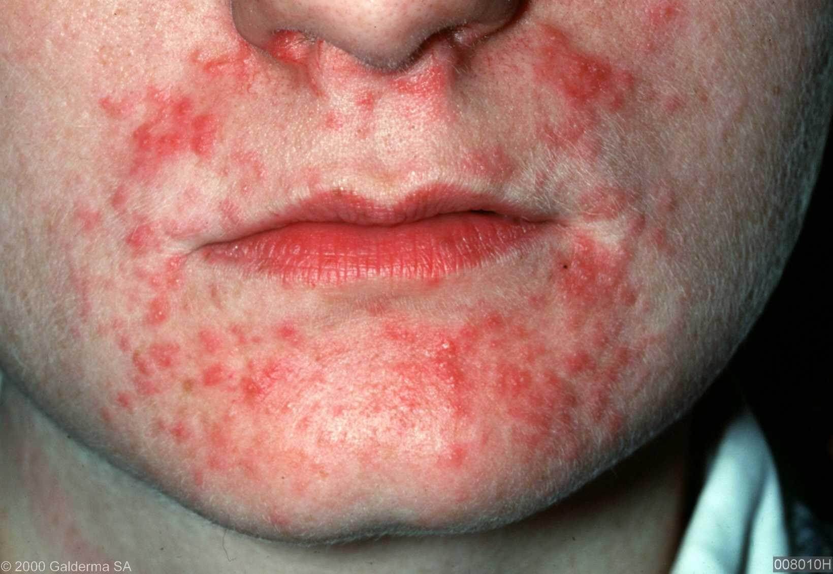 dermatitis-perioralis