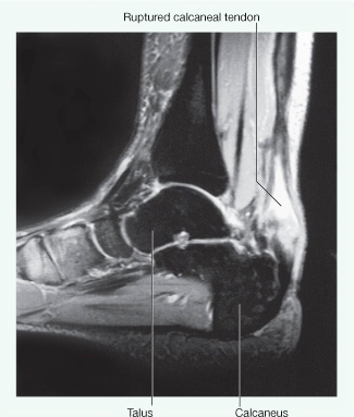 povrede-ligamenata