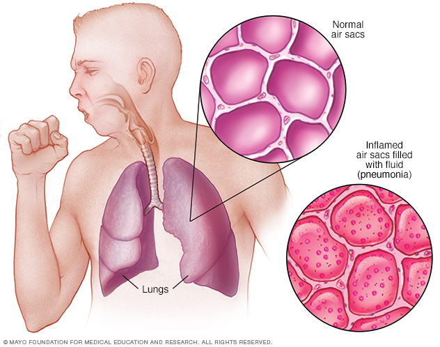 pneumonija