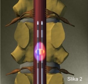 Neuromodulacija