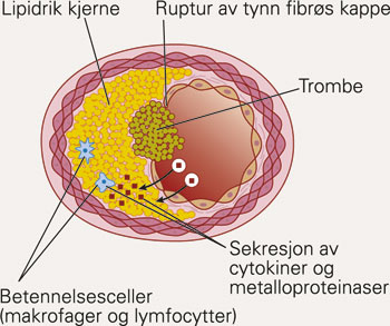 ACE inhibitori u prevenciji ateroskleroze, infarkta i šloga