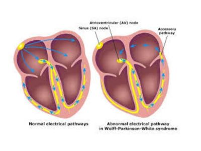U normalnom srcu pretkomorski impulsi mogu biti sprovedeni do komora samo preko AV čvora. Preekscitacija (aktivacija koja je ranija od normalne) postoji kada impuls iz pretkomora zaobilazi normalno atrioventrikularno zadržavanje i brzo se sprovodi do komora.