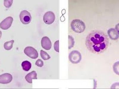 Megaloblastne anemije nastaju zbog smanjene sinteze DNK. Većina megaloblastnih anemija izazvana je nedostatkom vitamina B12 (perniciozna anemija) i/ili folne kiseline.