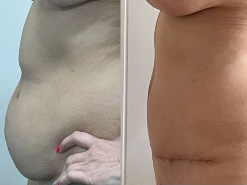 Zatezanje stomaka (abdominoplastika) - procedura, oporavak, rezultati