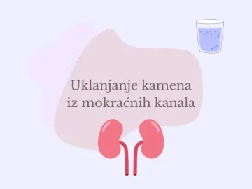 Uklanjanje kamena iz mokraćnih kanala